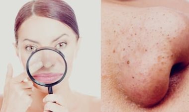 Blackheads Home Remedies: नाक और ठुड्डी के जिद्दी ब्लैकहेड्स से ऐसे पाएं छुटकारा, घर पर आजमाएं ये तरीके